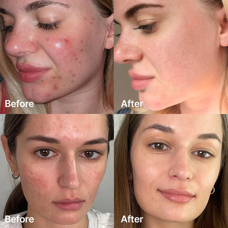 Medicube Red Acne Succinic Acid Peel 40g