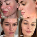 Medicube Red Acne Succinic Acid Peel 40g