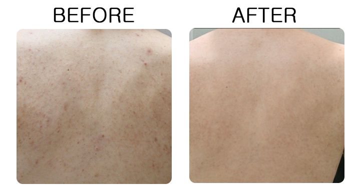 Medicube Red Acne Body Peeling Shot 110g