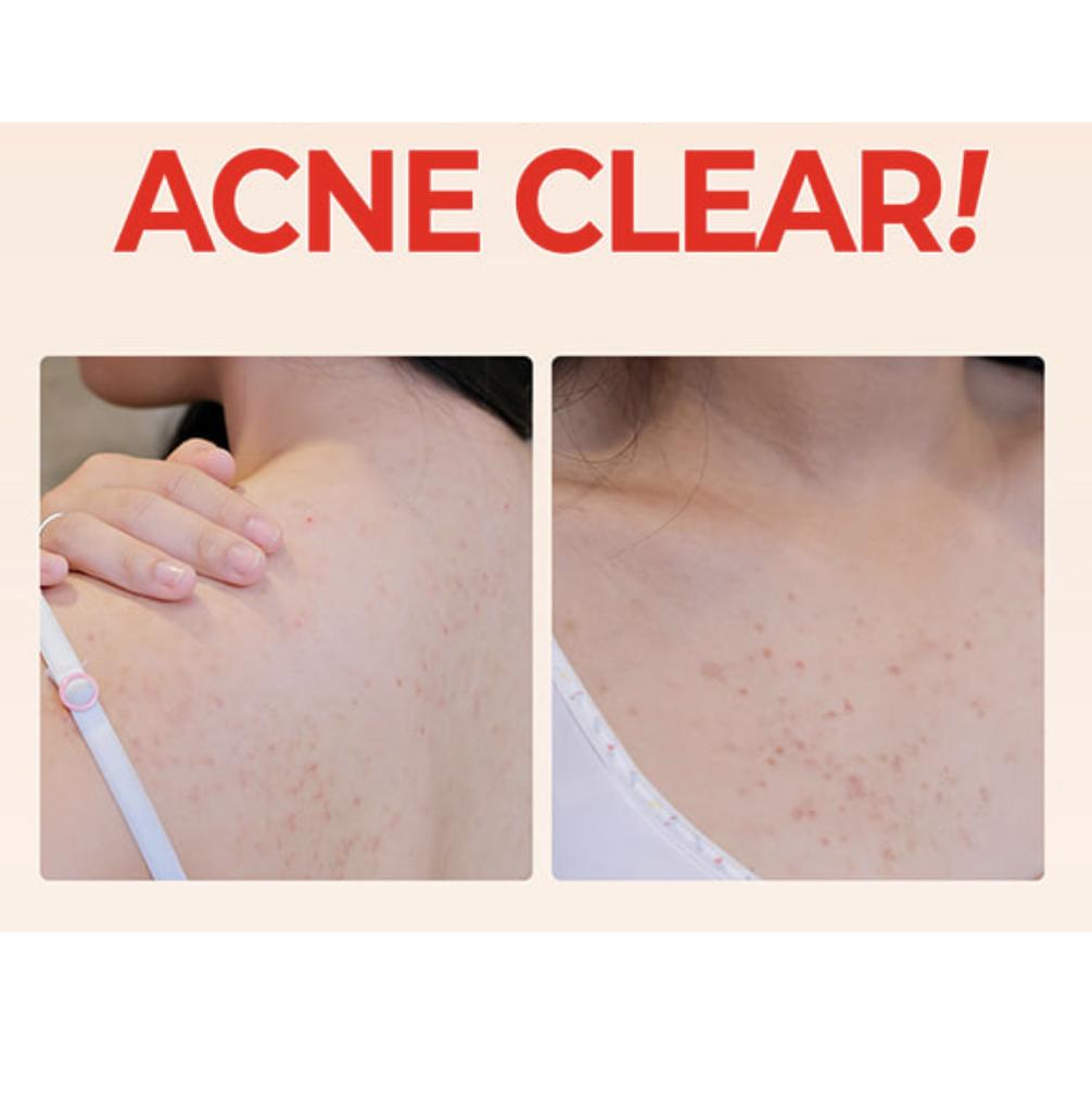 Some By MI Aha Bha Pha 30 Days Miracle Acne Clear Body Cleanser 400g