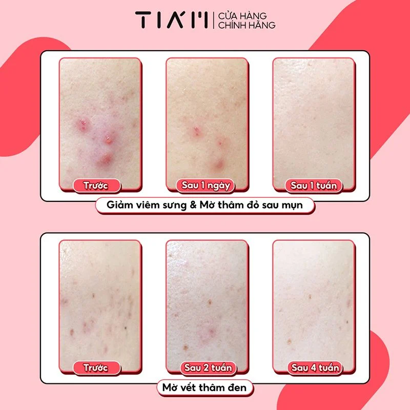 Tiam Ac Fighting Spot Rx Cream 30g