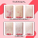 Tiam Ac Fighting Spot Rx Cream 30g